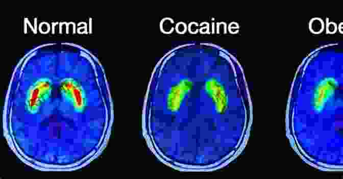 Brain Scan Showing The Effects Of Addiction What Is Addiction? : How To Stay Sober